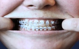 Dental Braces